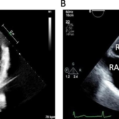 Transthoracic Echocardiogram Of Patient In Four Chamber View During