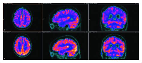 F Fluoro Deoxy D Glucose Positron Emission Tomography During And