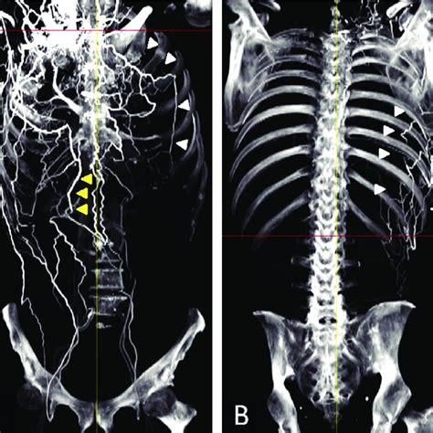 Preoperative Contrast Enhanced Ct Angiography Fig 2a Front View Fig Download Scientific