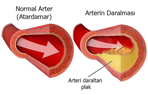 Serebrovask Ler Hastal K Nedir Doktor Fizik