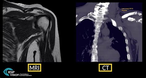 Rsip Vision Announces New Tool For Total Shoulder Arthroplasty Planning