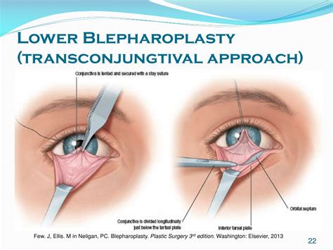 Ppt Comprehensive Guide To Blepharoplasty Surgery Powerpoint