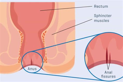 How Does an Anal Fissure Occur Avrupa Cerrahi Tıp Merkezi