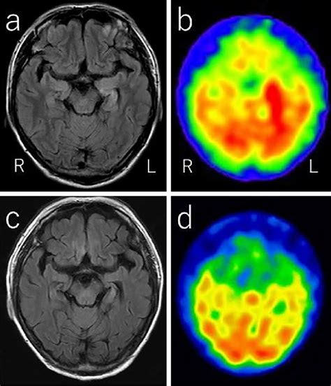 Figure1 Brain Imaging Radiological Findings Of Encephalitis Ab And