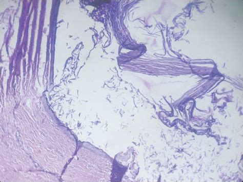 Histopathological Section Showing A Cyst Lined By Keratinized Squamous