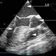 Mid Oesophageal Ascending Aorta Short Axis View Sax Anatomic