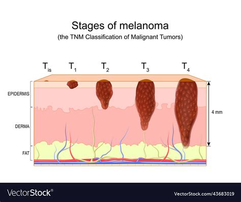 Stages of melanoma the tnm classification Vector Image