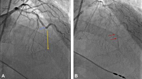 Lithoplasty Facilitated Proximal Cap Penetration Of A Calcified Chronic