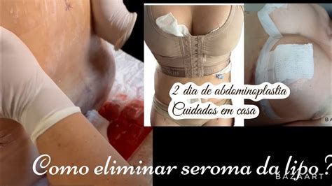 COMO ELIMINAR O SEROMA APÓS A ABDOMINOPLASTIA LIPOASPIRAÇÃO DIÁRIO DA