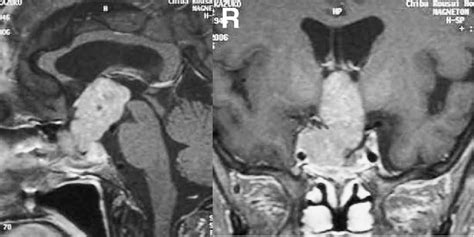 Figure From Endoscopic Endonasal Pituitary And Skull Base Surgery