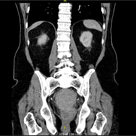 A Axial Ct View Demonstrating The Retroperitoneal Hematoma Displacing Download Scientific