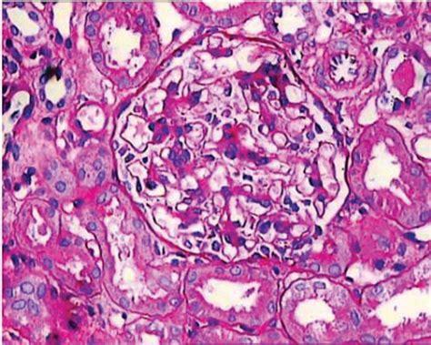 Most Of The Mesangialregions Exhibit Upto Four Mesangial Cell Nuclei