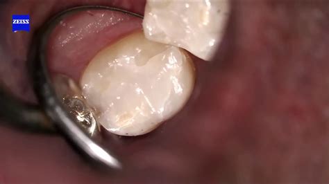 Recurrent Decay And Fracture Restoration 31 With Composite And Dental