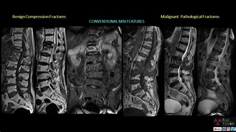 Benignosteoporotic Compression Vs Malignantpathological Fractures