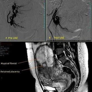 A C Uterine Artery Embolization Before Embolization After