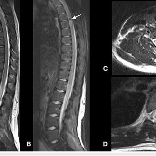 Sagittal T Weighted Mri Scans Of The Thoracic Spine A B And Axial