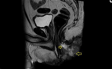 Mucinous Adenocarcinoma Mri Mri Fistula Associated Mucinous