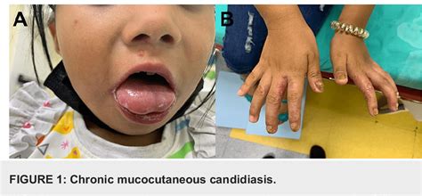 Figure From A Novel Homozygous Mutation Of Aire Gene In A Patient