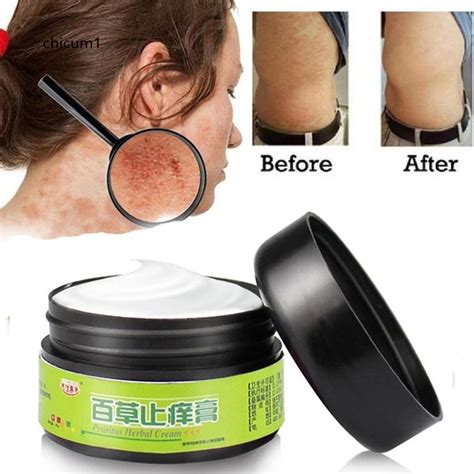 CHI Effective Herbal Ointment Dermatitis Psoriasis Eczema Cream Anti