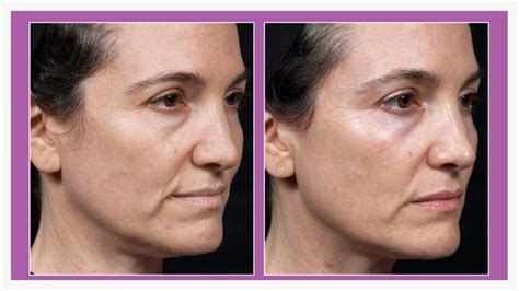 Radio Frequency Skin Tightening Bellissimo You