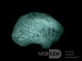 Osteoma Ear Canal [microradiograph] • Image • MEDtube.net