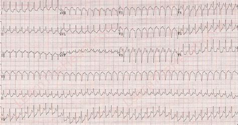 Atrial Flutter • Litfl • Ecg Library Diagnosis 45 Off