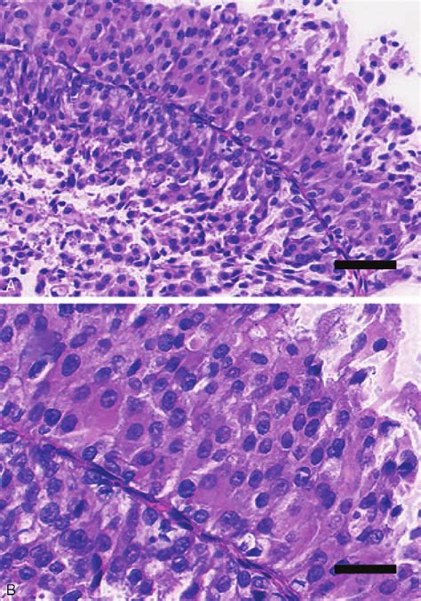 Histological Features Hematoxylin And Eosin Staining Of Low Grade