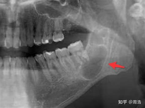 下颌骨囊肿手术经历 知乎