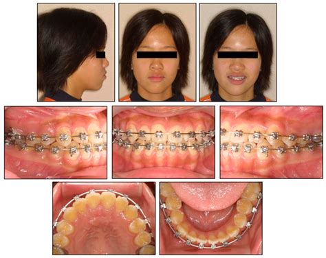 Applied Sciences Free Full Text Nonsurgical Correction Of Anterior