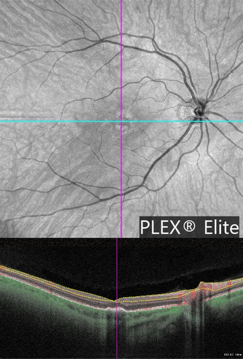 Ophthalmology Dx: Identify the Etiology of This Unilateral Scotoma ...