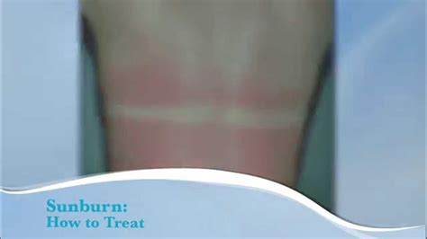 How To Treat Sunburn PHDermatology