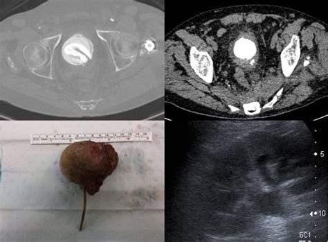 Invaginaci N Ileoc Lica En Un Paciente Con Fibrosis Qu Stica La