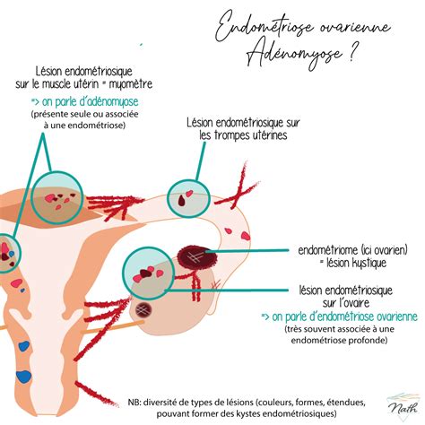 Endom Triose Et Ad Nomyose Nathalie Faggianelli