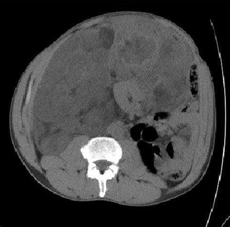 Ct Scan Showing The Large Retroperitoneal Sarcoma Ct Computed