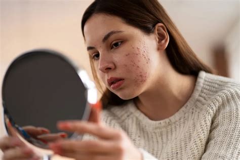 Hormonal Acne Treatment In Indore Causes Symptoms Trea