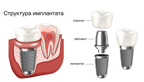 Имплантация Neobiotech