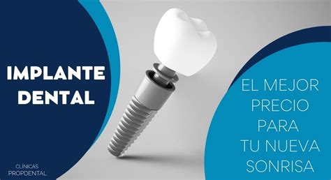 Implantes Dentales Barcelona Precio Poner Toda La Boca Con Implantes