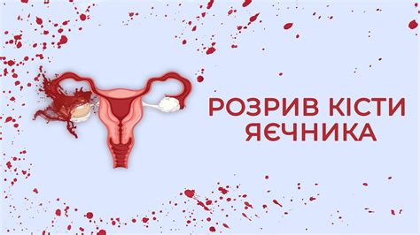 Розрив кісти яєчника, що робити в цьому випадку? | Гринда Ігор ...