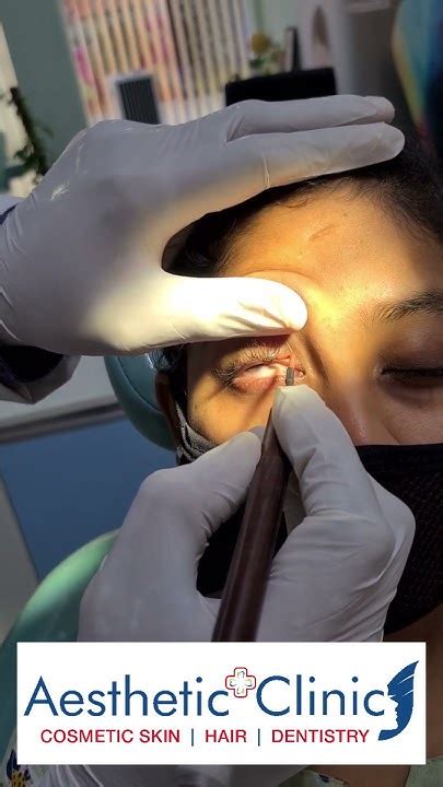 Eye Cyst Removal Through Minor Surgery Bangalore Call Us 7676795999