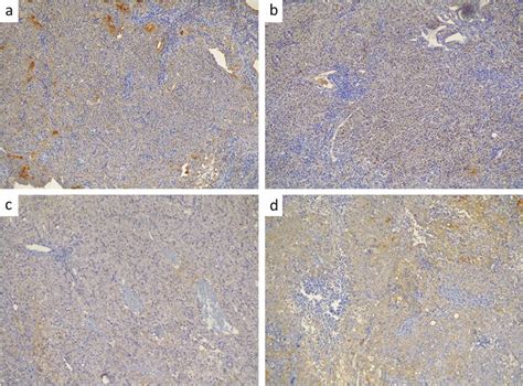 Immunohistochemical Staining Of Survivin In Neoplastic Tissue