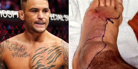 La Estrella De Ufc Dustin Poirier Muestra Un Horrible Pie Hinchado En