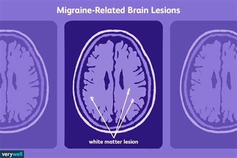 Understanding Migraine Related Brain Lesions On Your MRI