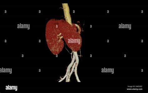 Cta Renal Artery 3d Is A Medical Imaging Procedure Using Ct Scans To Examine The Renal Arteries