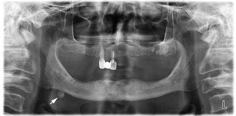 Sialoliths Of Submandibular Gland And Whartons Duct Orthopantomography