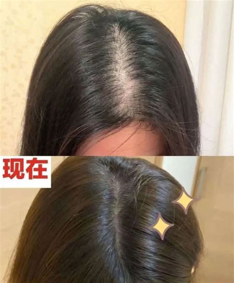 女性脂溢性脱发，如何有效治愈？三甲植发医师李宁 哔哩哔哩