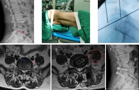 Frontiers Extreme Lateral Interbody Fusion Xlif Approach For L5 S1