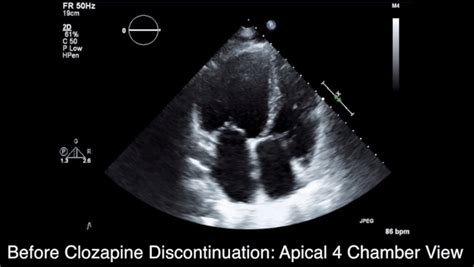 Takotsubo Cardiomyopathy 