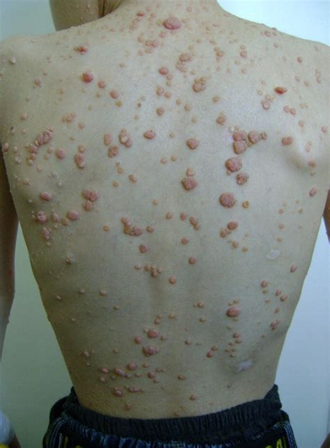 Molluscum Contagiosum Virus