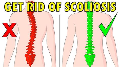 How To Fix Scoliosis Naturally In 4 Minutes A Day Artofit