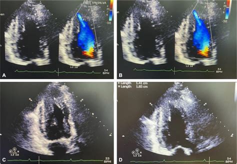 Yamaguchi Syndrome An Updated Review Article Of Electrocardiographic